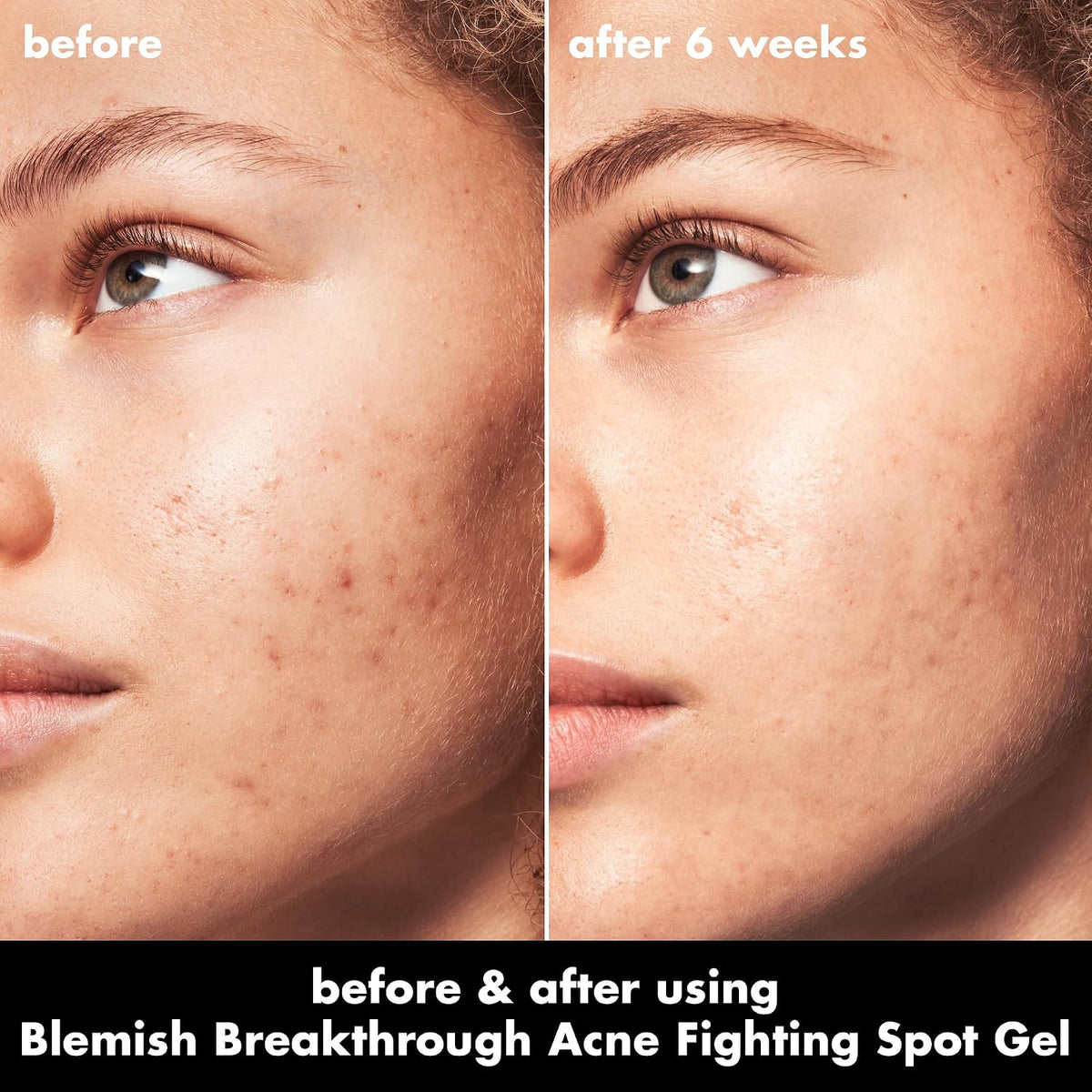 e.l.f. SKIN Blemish Breakthrough Blemish Fighting Spot Gel. Roll-on Blemish Spot Gel For Targeting & Treating Blemishes. Infused With Salicylic Acid