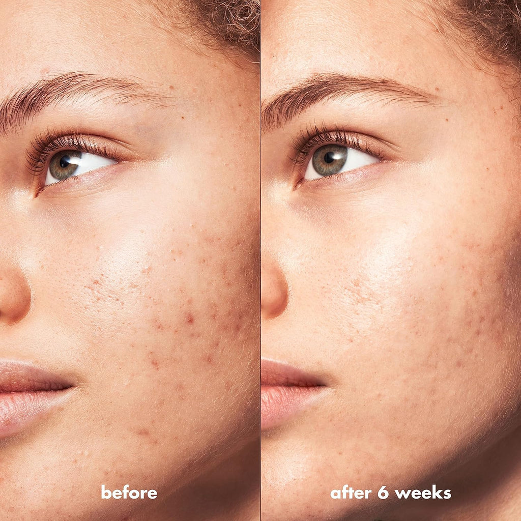 e.l.f. SKIN Blemish Breakthrough Clarifying Cleanser. Gel Cleanser For Removing Makeup. Controlling Oil & Clarifying Pores. 1% Salicylic Acid
